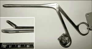 The-Weil-Blakesley-conchotome BC blog Oct 2018